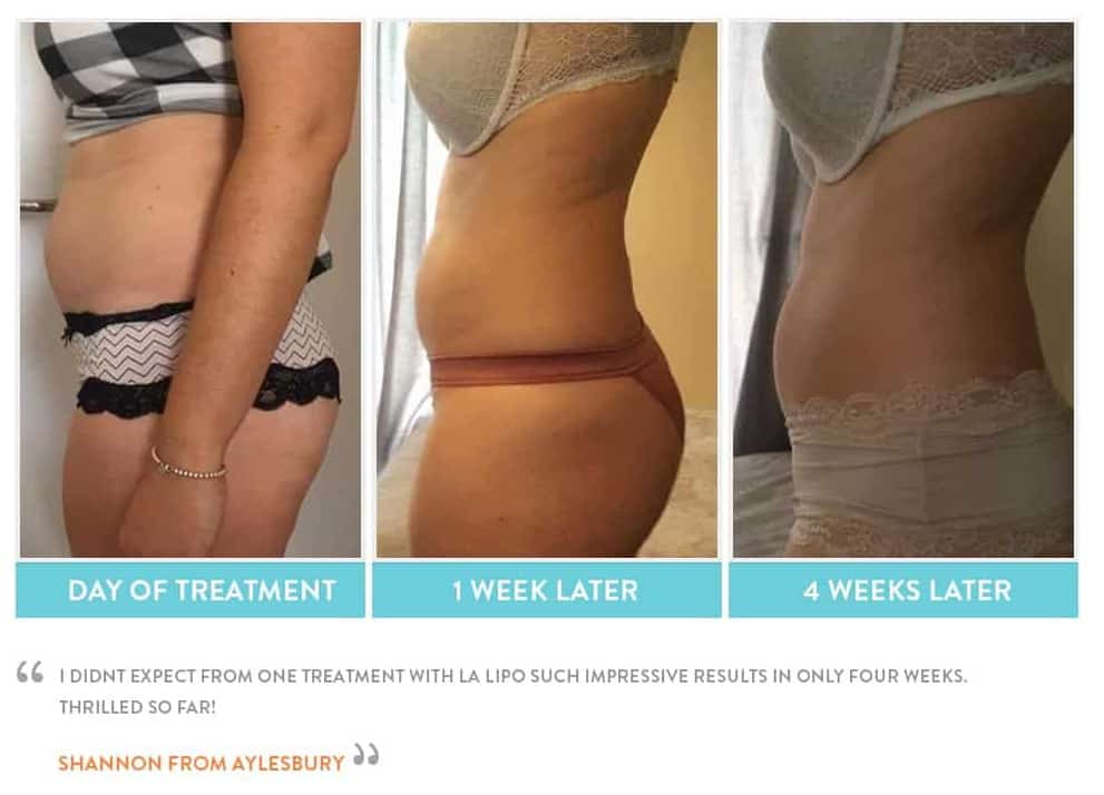 before, Cryolipolysis Royal Tunbridge Wells