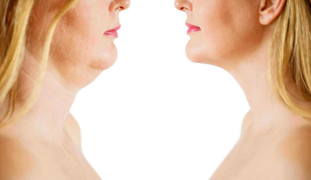 Double Chin treatment Royal Tunbridge Wells before and after results