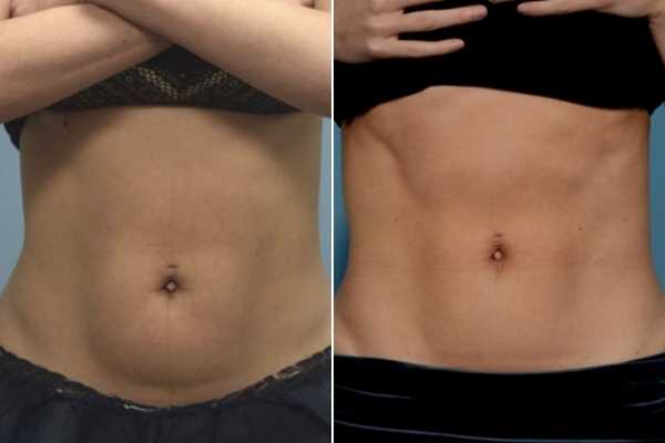 body sculpting FAQs Royal Tunbridge Wells