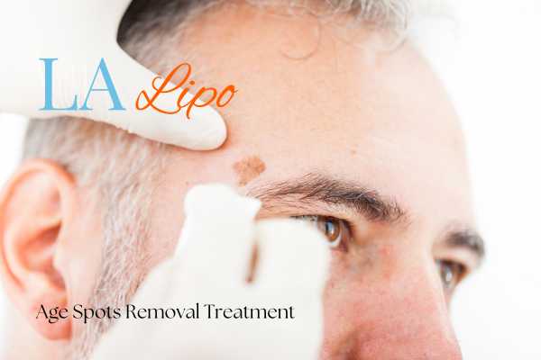 What Are the Most Effective Treatments for Age Spots Royal Tunbridge Wells?