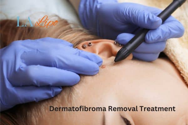 Dermatofibroma Removal Treatment Royal Tunbridge Wells