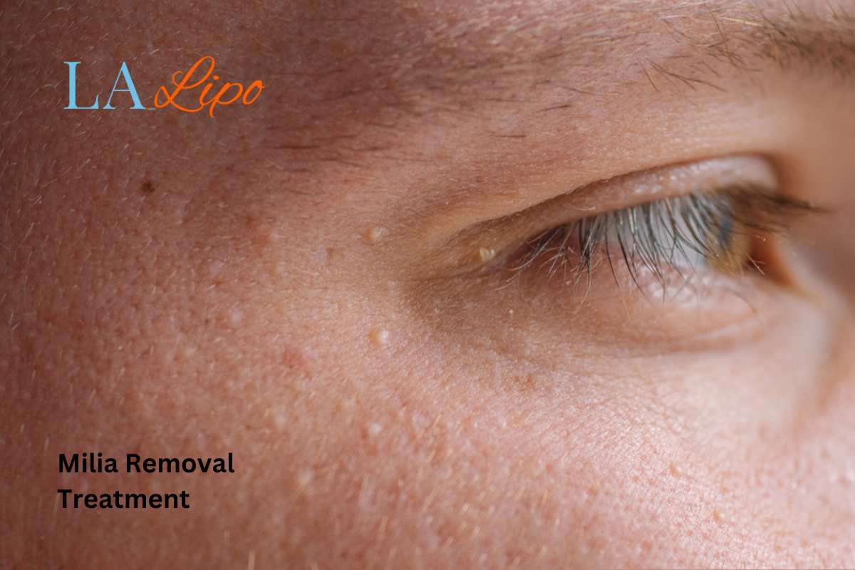 Cryopen Milia Removal: Is It the Easiest and Safest Option Royal Tunbridge Wells?