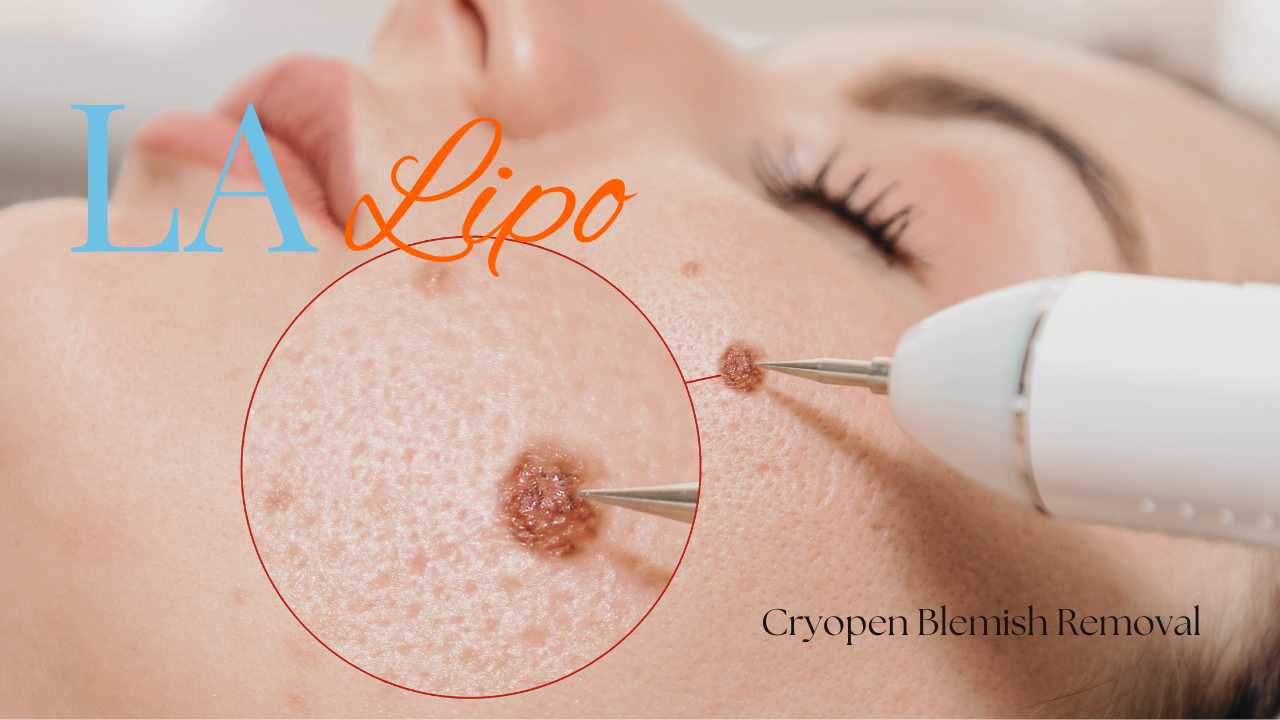 cryopen blemish removal Royal Tunbridge Wells Contact our team today!
