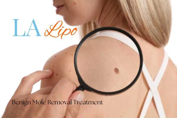 Woman having her inspection of blemish before mole removal Royal Tunbridge Wells
