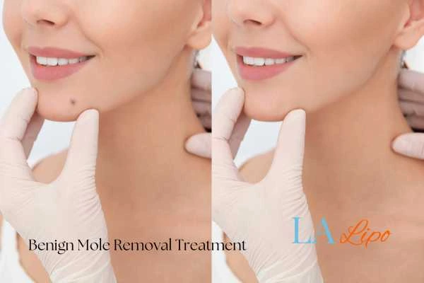 Before and after mole removal Royal Tunbridge Wells treatment