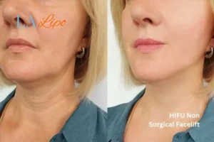 hi-fu for wrinkles Royal Tunbridge Wells before and after results