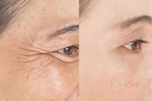 Before and after results of woman - HI-fu wrinkles reduction treatment Royal Tunbridge Wells