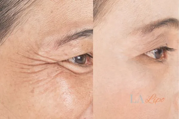 Before and after results of woman - HI-fu wrinkles reduction treatment Royal Tunbridge Wells
