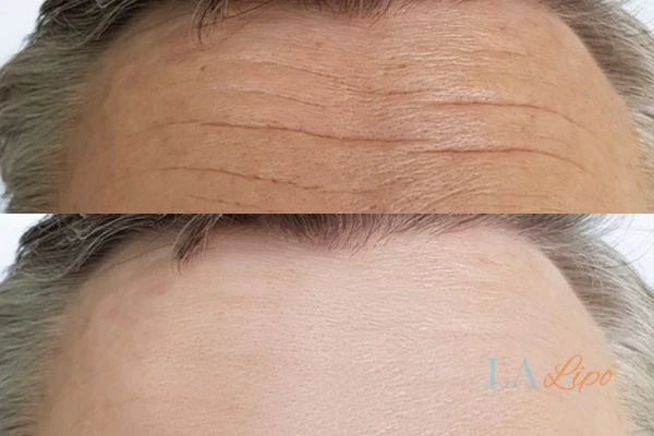 results of HIFU Royal Tunbridge Wells on mans forehead to help reduce lines and wrinkles