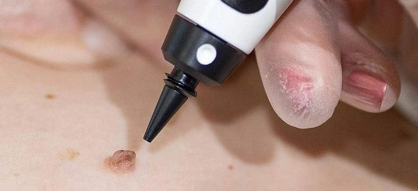 skin tag removal using cryopen Royal Tunbridge Wells
