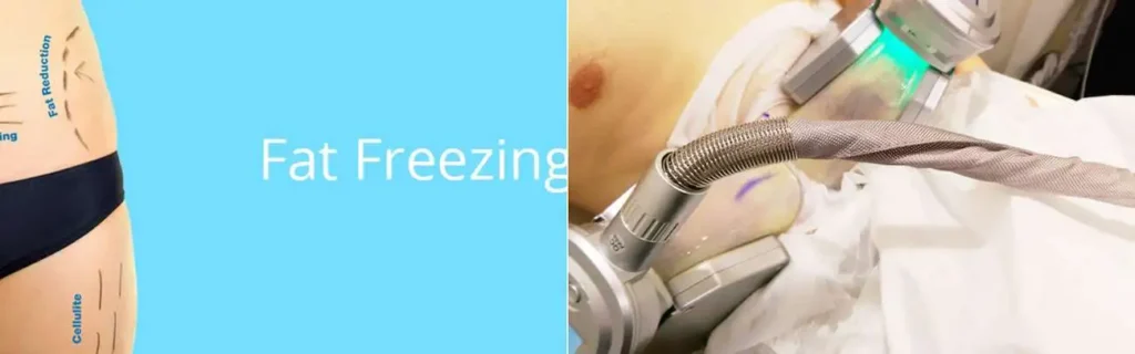 Fat freezing Royal Tunbridge Wells on multiple areas of the body
