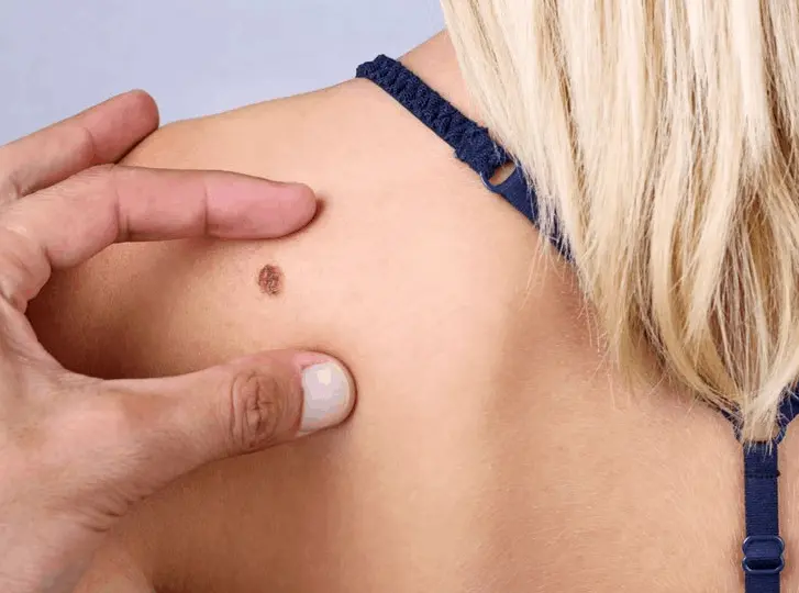 woman having mole removal Royal Tunbridge Wells consultation before treatment.