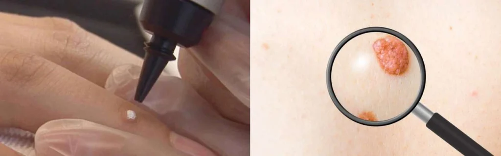 CryoPen practitioner Royal Tunbridge Wells assessing a benign mole before treatment