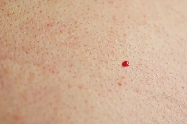 close up of a cherry angioma Royal Tunbridge Wells