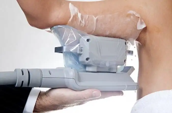 Picture of fat freezing Royal Tunbridge Wells on the upper arms.