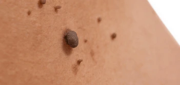 image of a skin tag Royal Tunbridge Wells