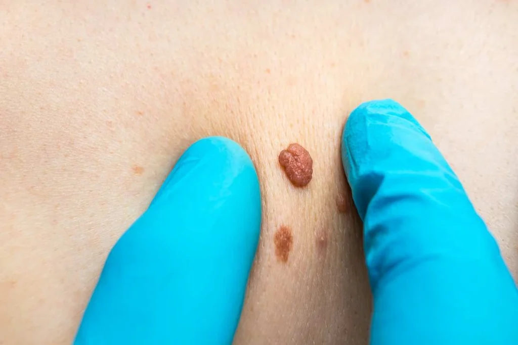 Consultant examining a skin tag Royal Tunbridge Wells