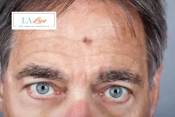 Solar Lentigo Removal Royal Tunbridge Wells image of man with mark on his forehead