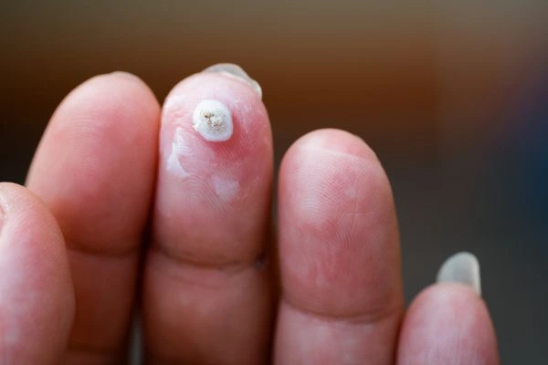 wart on person finger - cryotherapy to treat from LA LIPO Royal Tunbridge Wells