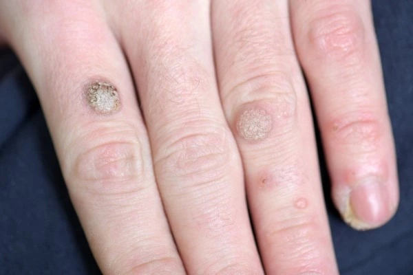 photo of warts on person hand - see wart removal Royal Tunbridge Wells from LA LIPO