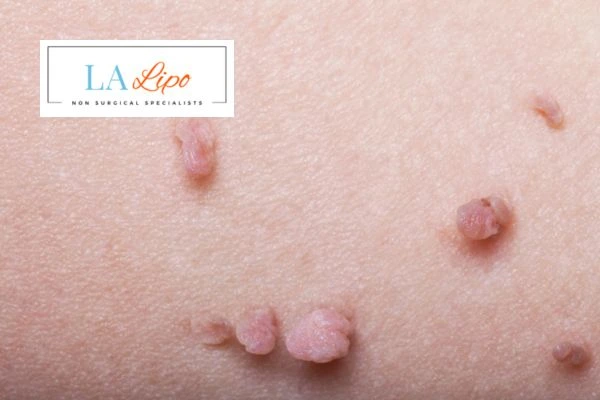 Does cryopen skin tag removal Royal Tunbridge Wells hurt? Find out now call our team today!