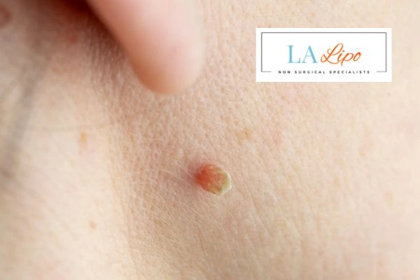Book skin tag removal Royal Tunbridge Wells today speak to our team now!