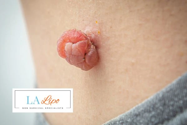 Interested in skin tag removal Royal Tunbridge Wells? Concerned about the pain? Find out more today!