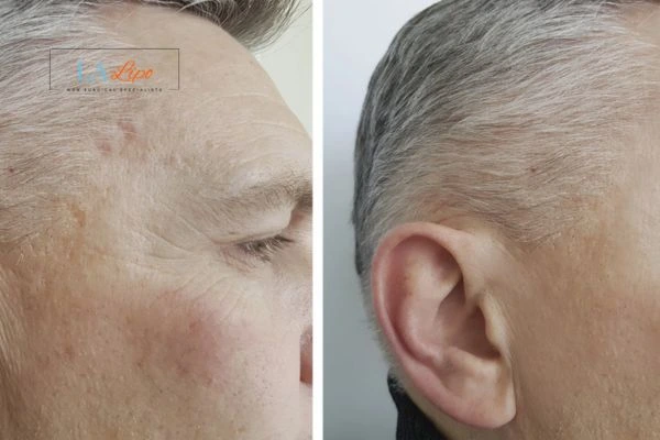 Mens Before & After Morpheus 8 Results Royal Tunbridge Wells