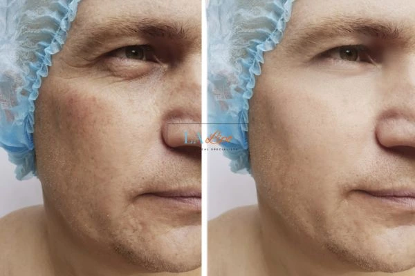 Before and after Morpheus 8 Results Royal Tunbridge Wells