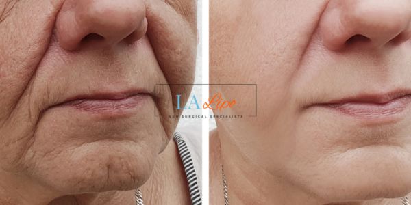 Older lady deeper wrinkle reduction - LA LIPO Morpheus 8 Results Royal Tunbridge Wells