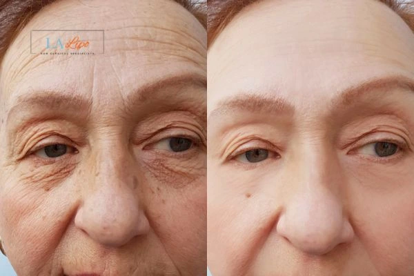 The powerful benefits of Morpheus8 Treatment Royal Tunbridge Wells - Call Our team today!