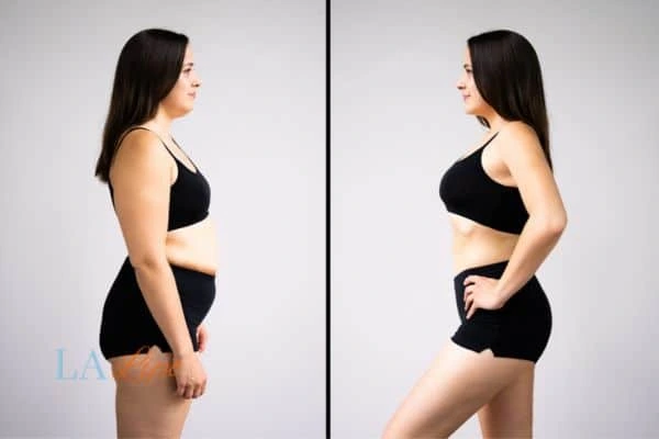 Picture of womans before and after using LA-EMS body sculpting to improve her core strength Royal Tunbridge Wells