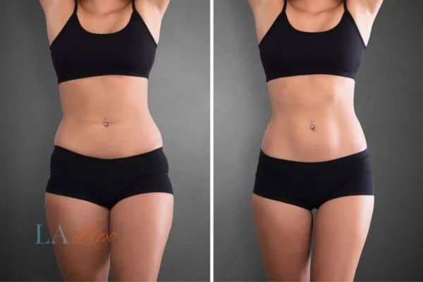 before and after results of non-surgical treatment to help a woman's body image and mental health Royal Tunbridge Wells