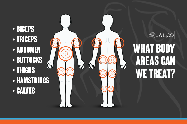 Diagram to show areas you can have LA-EMS Body Sculpting Treatment Royal Tunbridge Wells