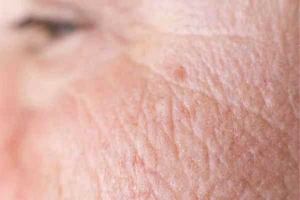 close up picture of a woman's face showing an age spot Royal Tunbridge Wells