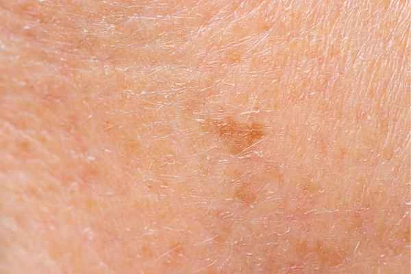 close up picture of age spots Royal Tunbridge Wells