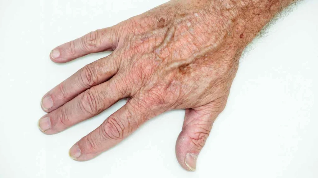 Male hand showing age spot Royal Tunbridge Wells
