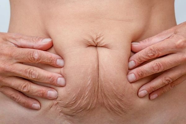 Should I Combine Diastasis Recti Treatment with Body Contouring for Better Results Royal Tunbridge Wells?
