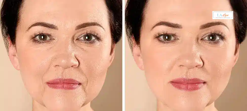 How Long Does It Take to See Results and How Long Do They Last Royal Tunbridge Wells?
