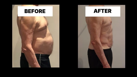 What Symptoms Can Diastasis Recti Cause in Men? Weak Core, Back Pain and Poor Posture Royal Tunbridge Wells